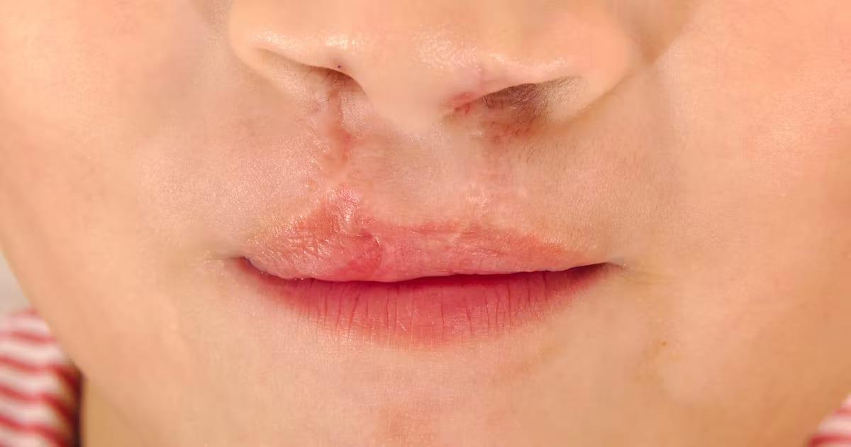 Free surgery programme launched for children with cleft lip, palate | Others