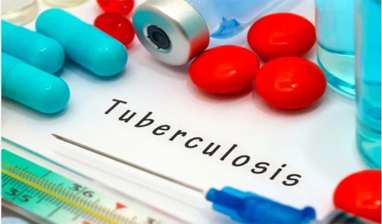 Early diagnosis, treatment key to curing drug-resistant TB: experts | News Flash
