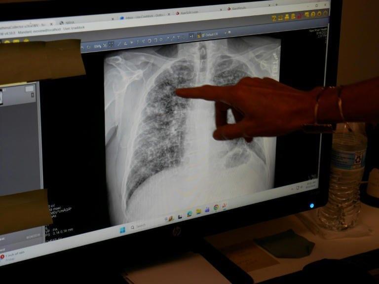 In US mining hub, black lung rates soar | International